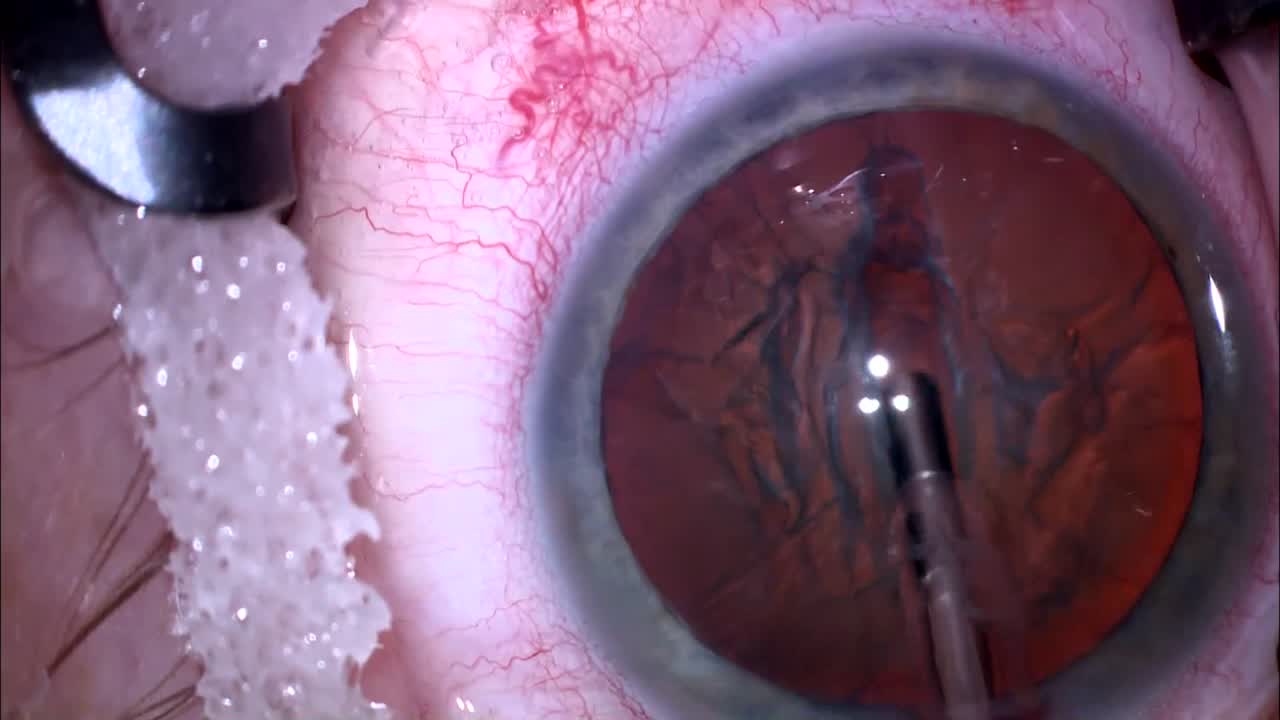 Late Vitreous