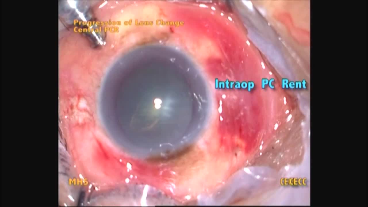 Previous Vitrectomy