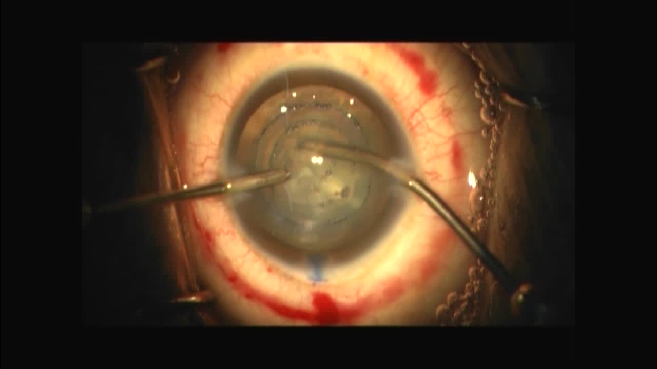 Previous Injection