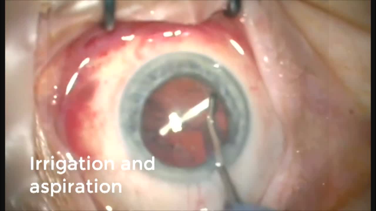 Dexamethasone Assault