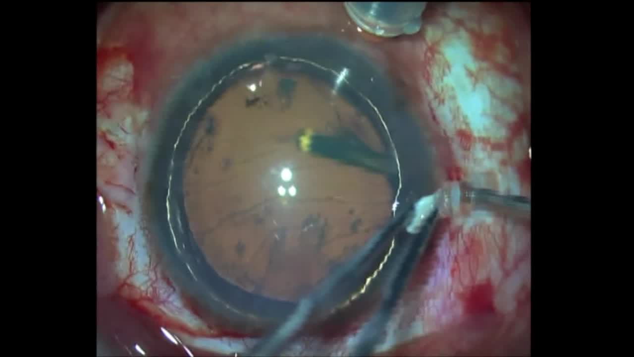 Subluxed Cataract