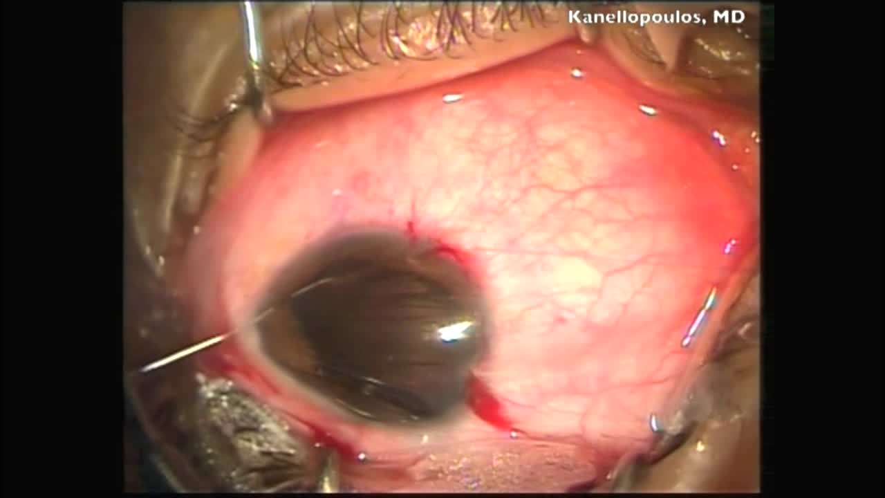 Pediatric Iris Claw