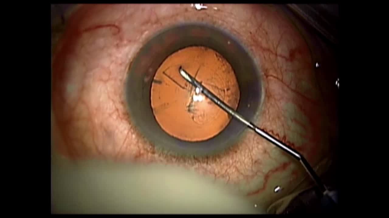 Routine Case Performed By Warren Hill, MD