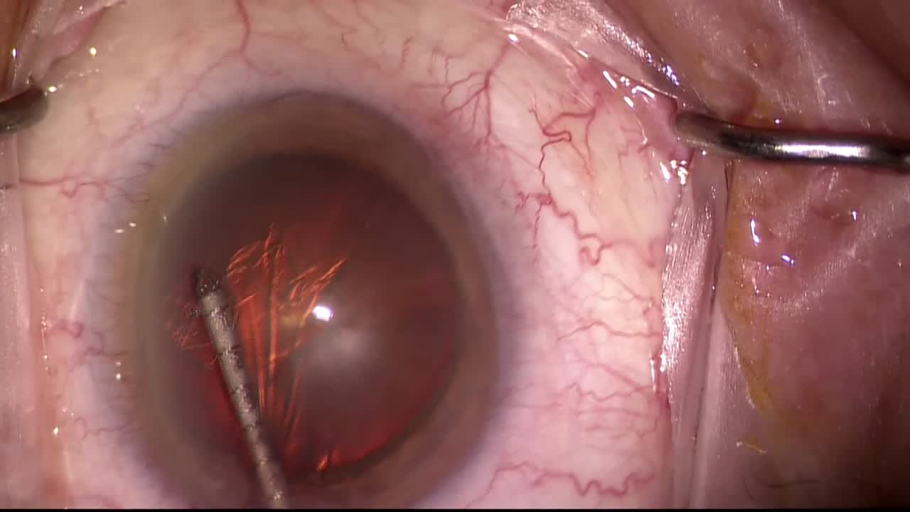 Routine Case Performed By Michael Snyder, MD