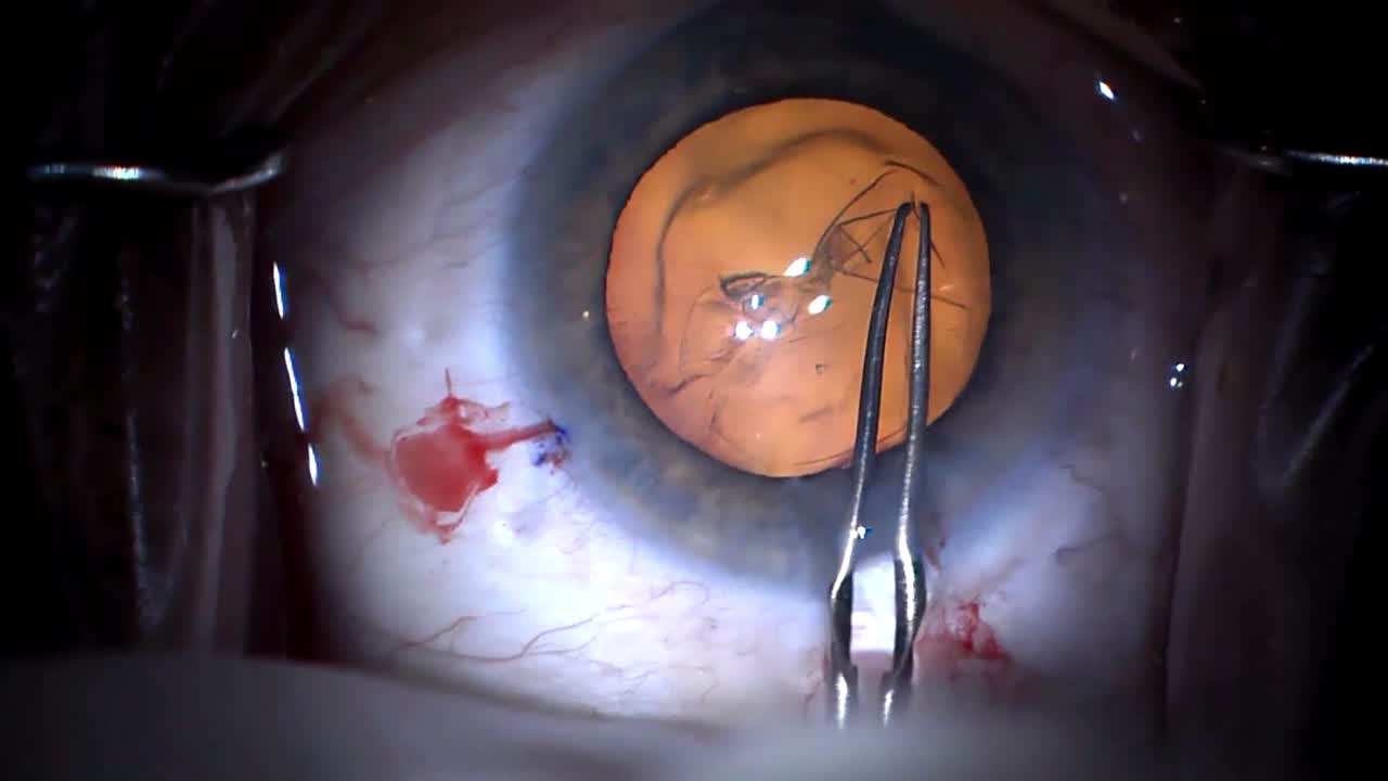 Routine Case Performed By Thomas Oetting, MD