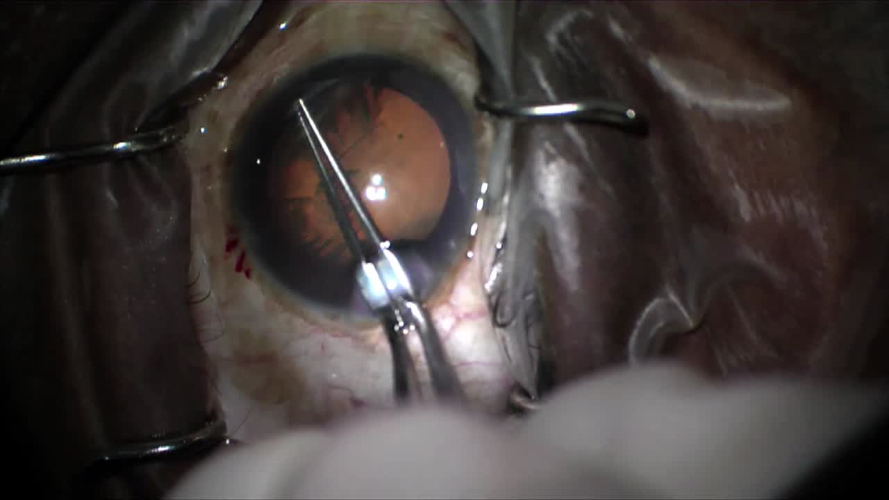 Routine Case Performed By Mark Blecher, MD