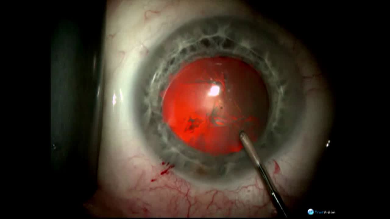 Routine Case Performed By Robert Weinstock, MD