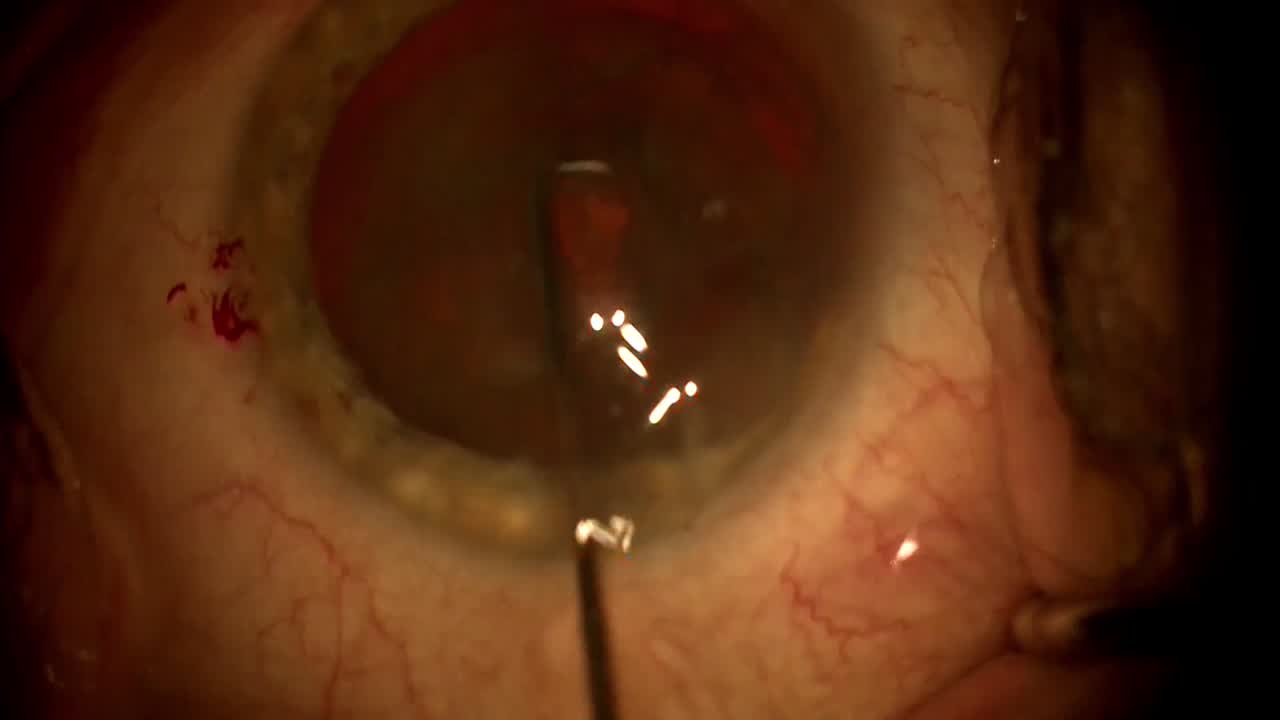Routine Case Performed By Cathleen McCabe, MD