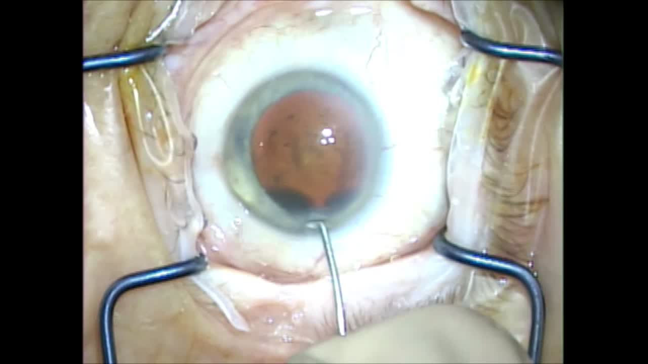 Routine Case Performed By Toby Tyson, MD