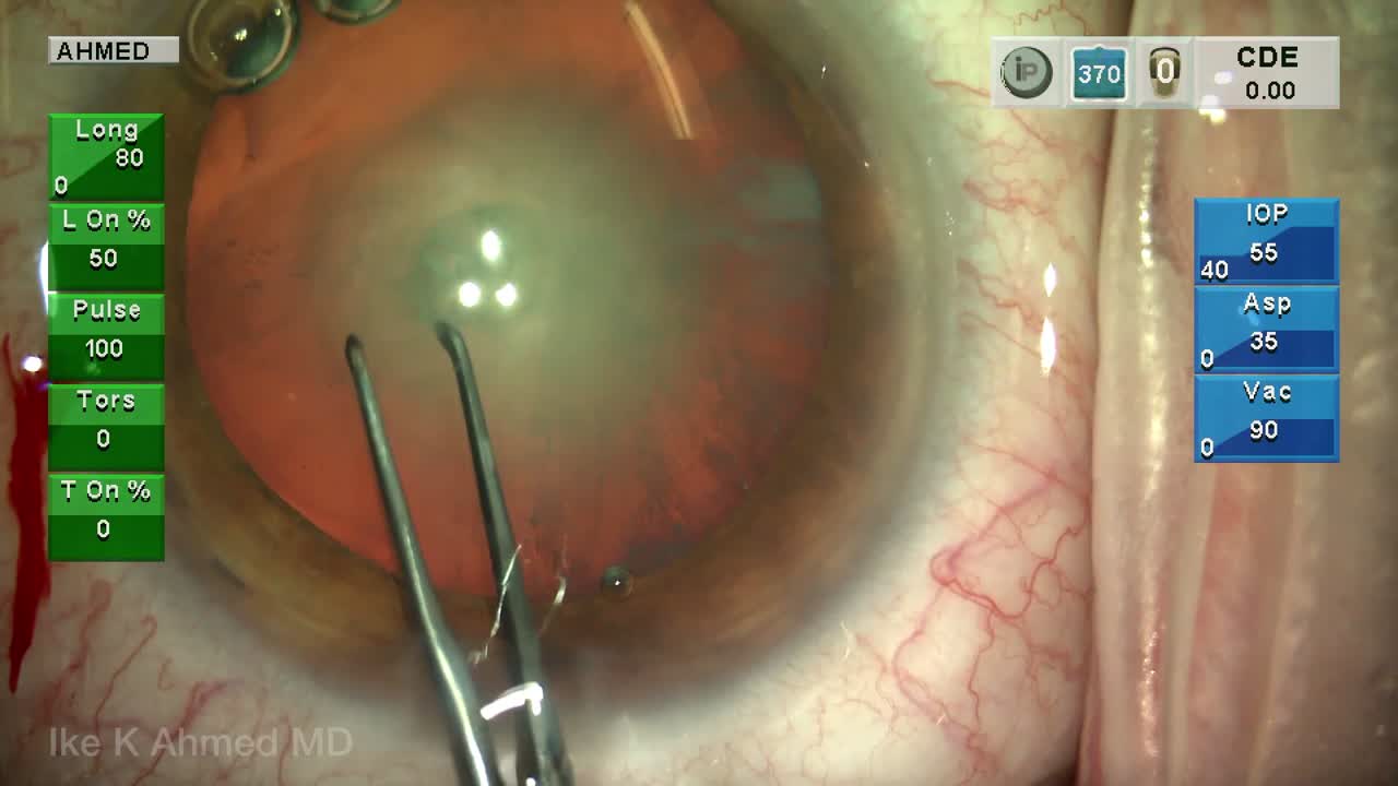 Routine Case Performed By Ike Ahmed, MD