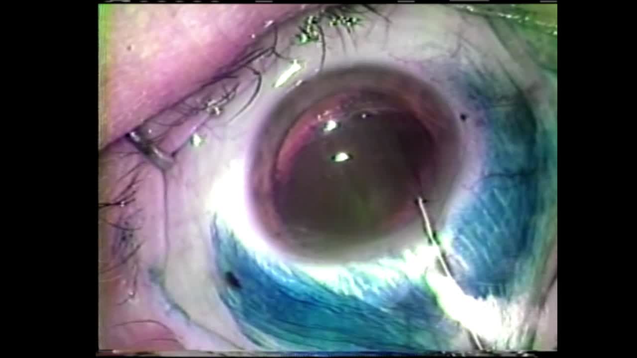 Evolution of Phaco Techniques: A 50-Year Odyssey
