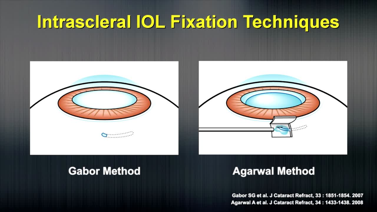 Transconjunctival Intrascleral IOL Fixation with Double-Needle Technique