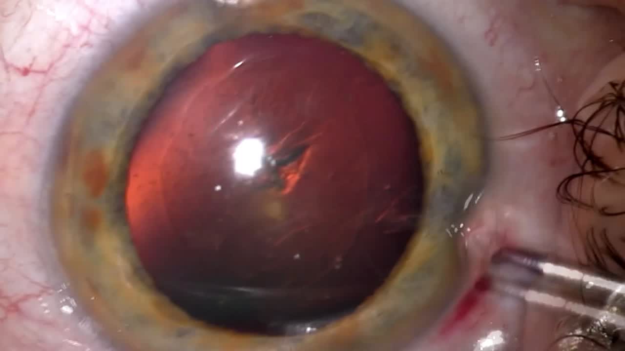 CAPSULaser: A New Laser Approach for Capsulotomy