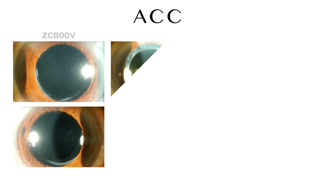 Prevention of Anterior Capsulorhexis Contraction
