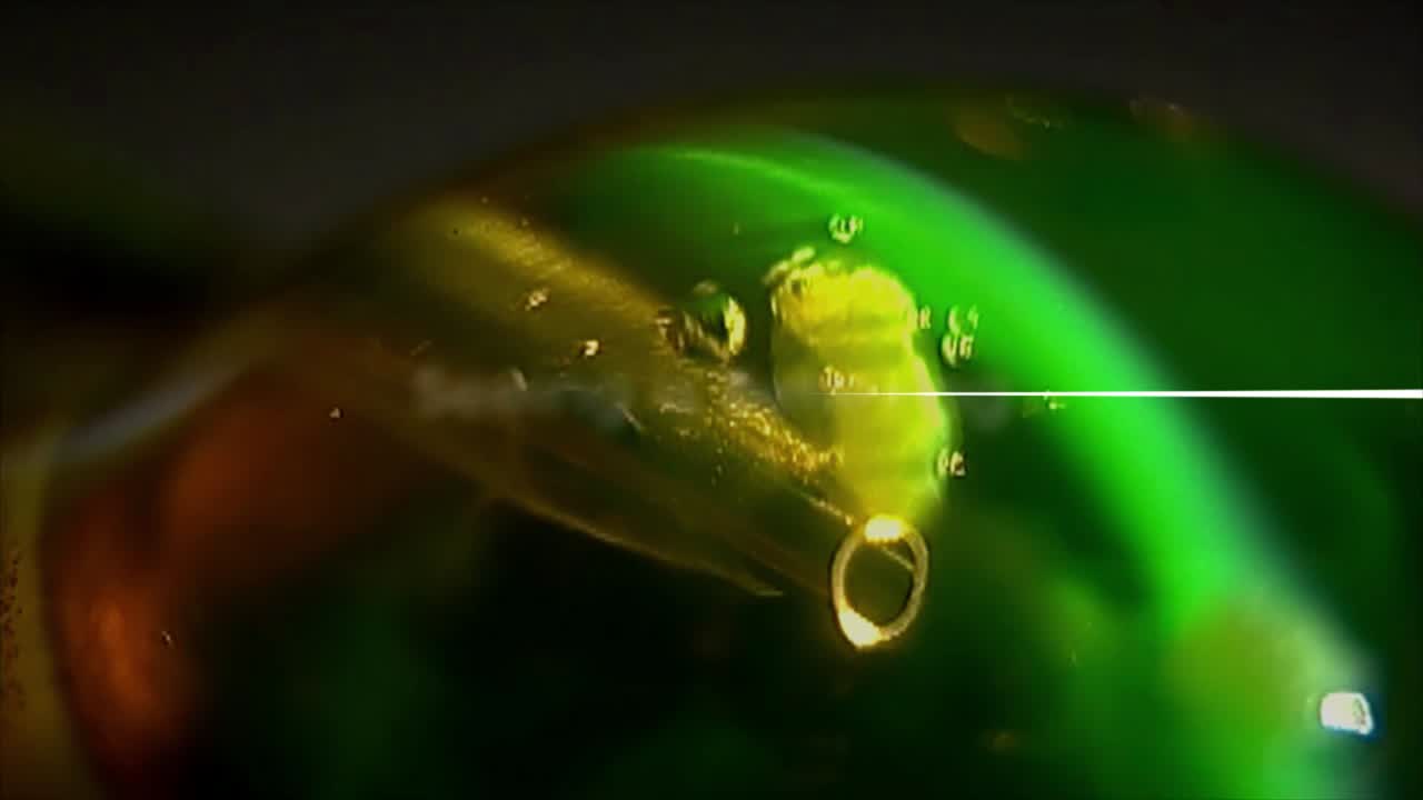 Observation of Anterior Chamber with Slit Lamp during Cataract Surgery