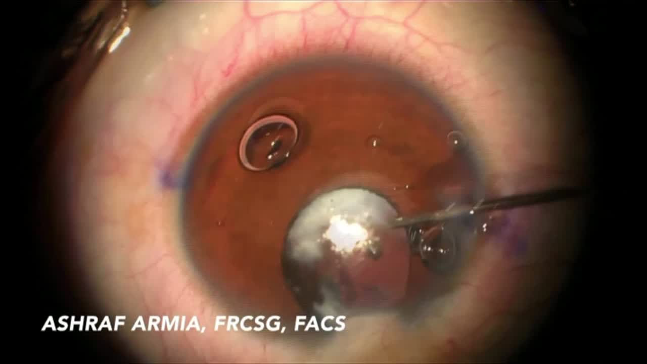 Creating a Pupil after 20 Years
