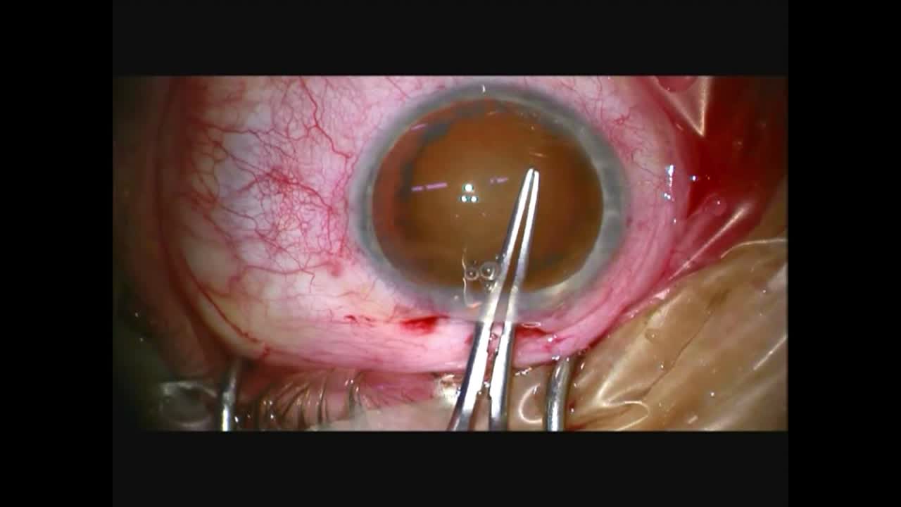 3 Implants in 1 Capsule