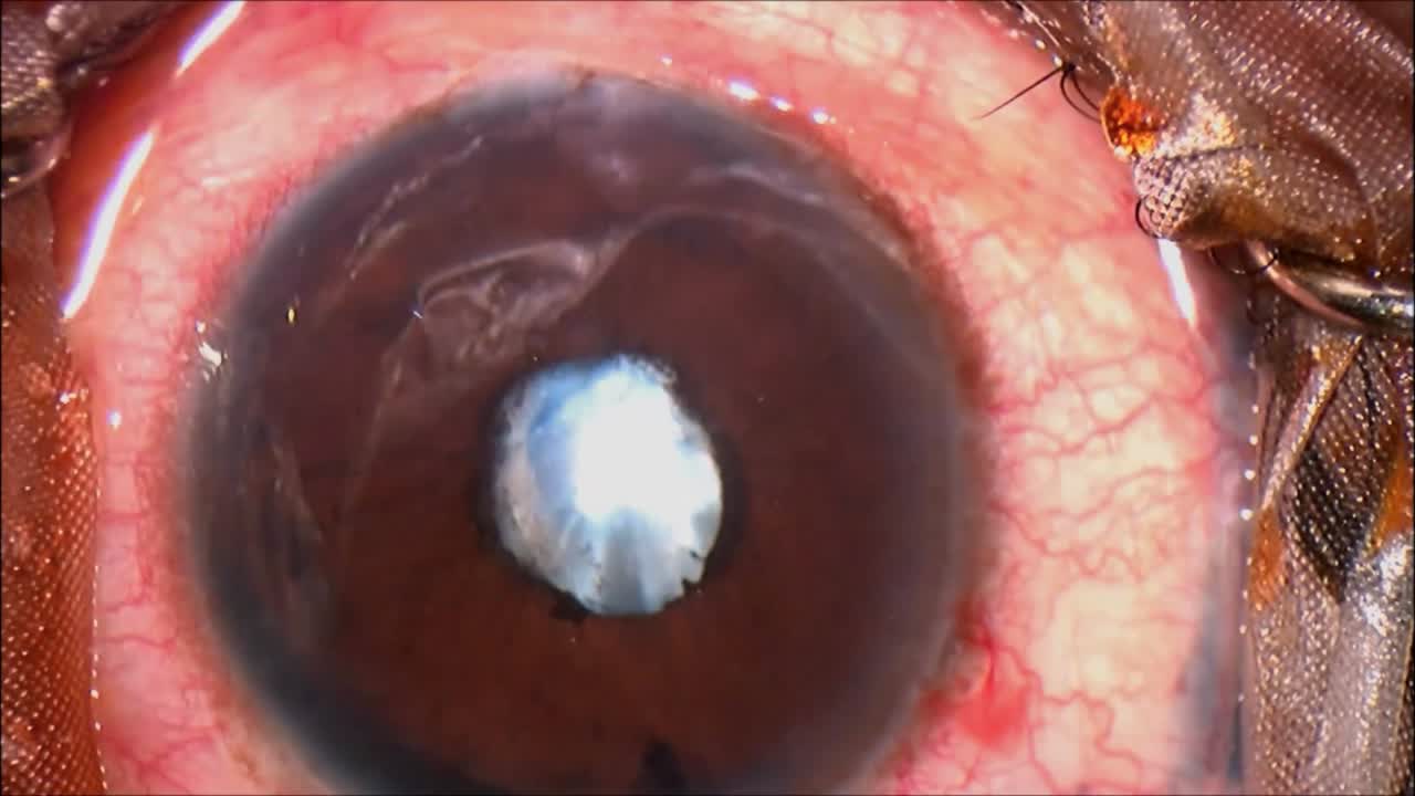 Uveitis with Peripupillary Membranectomy