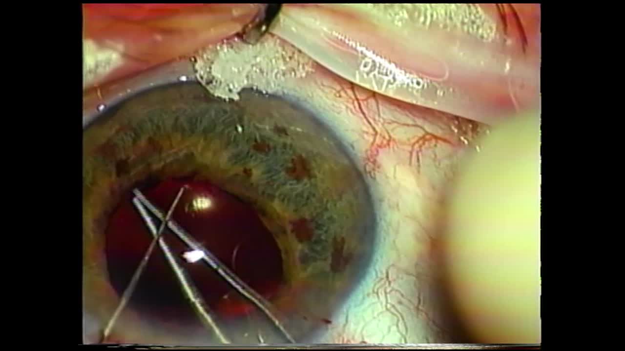 My First Peripupillary Membranectomy