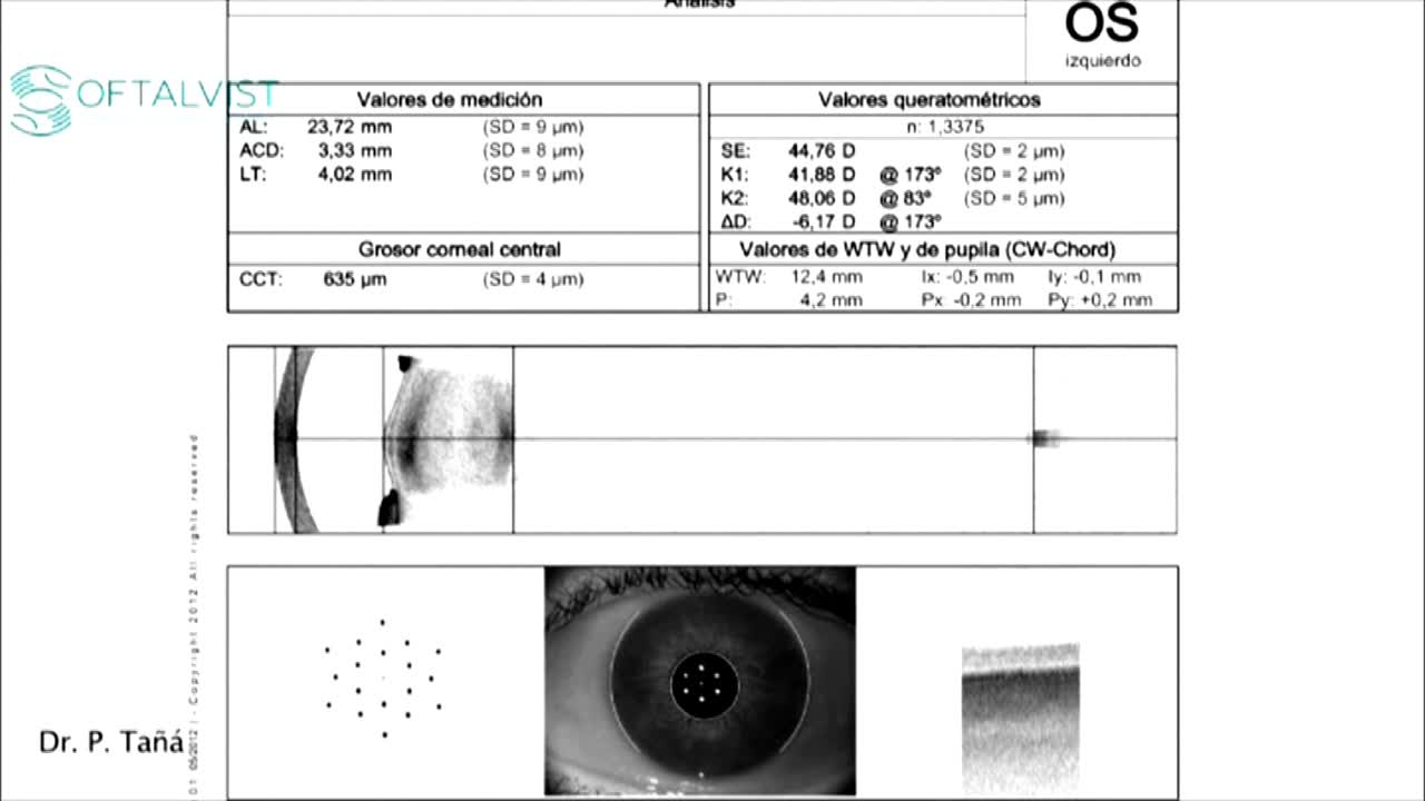 Alport Syndrome with Lenticonus