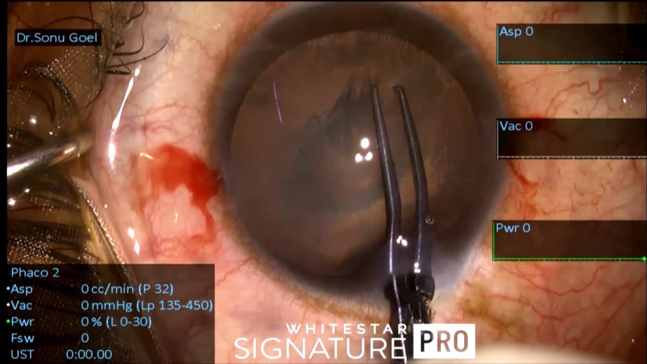 Preexisting Posterior Capsule Opening