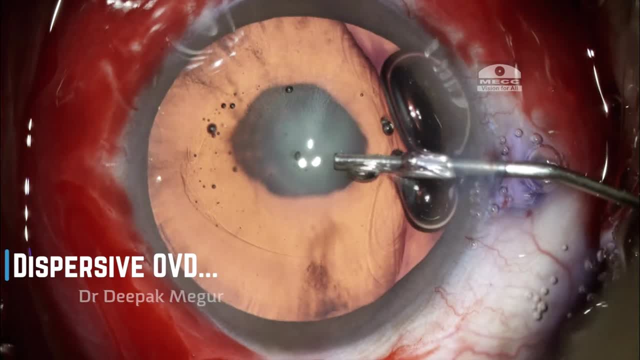 Posterior Polar Cataract:  4 Situations