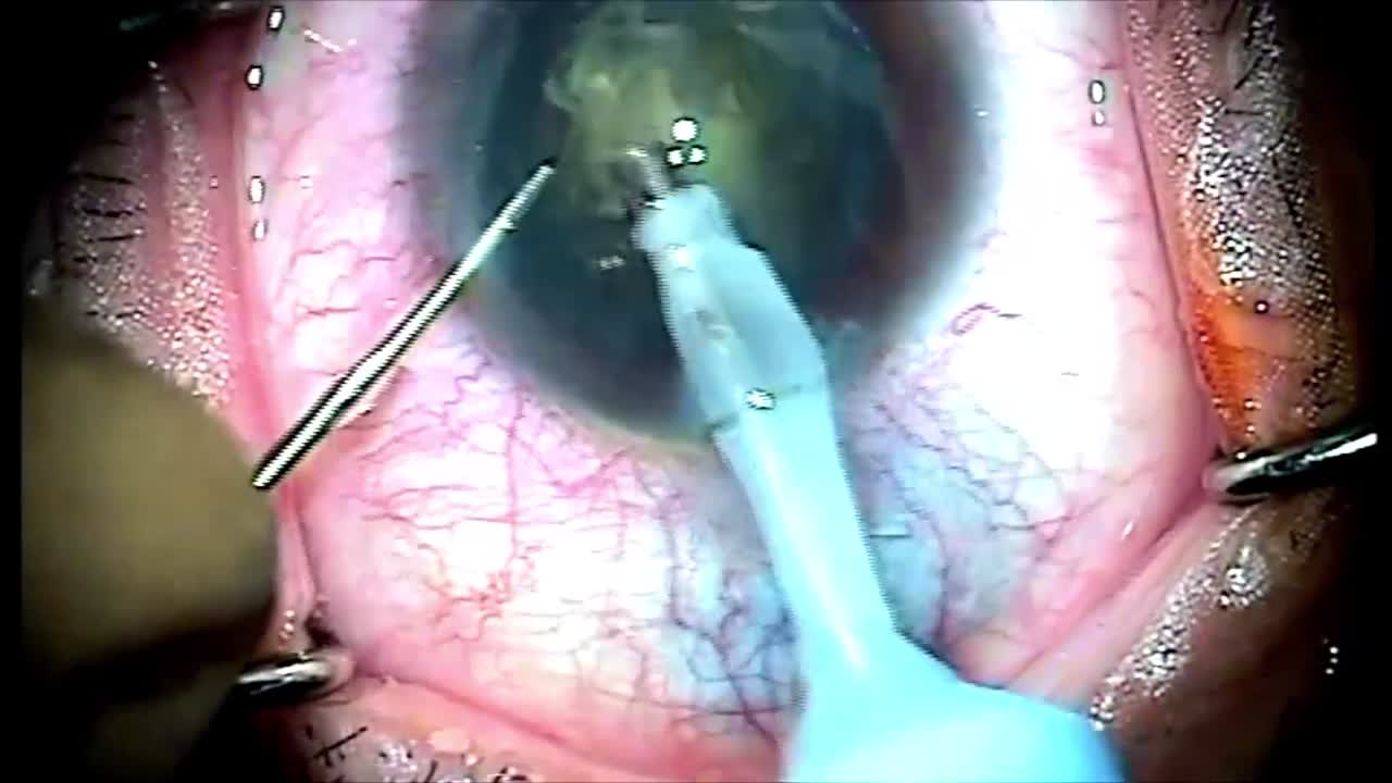 Posterior Polar Cataract:  4 Situations