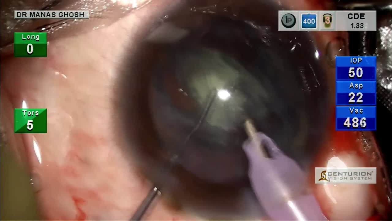 Posterior Polar Cataract:  4 Situations