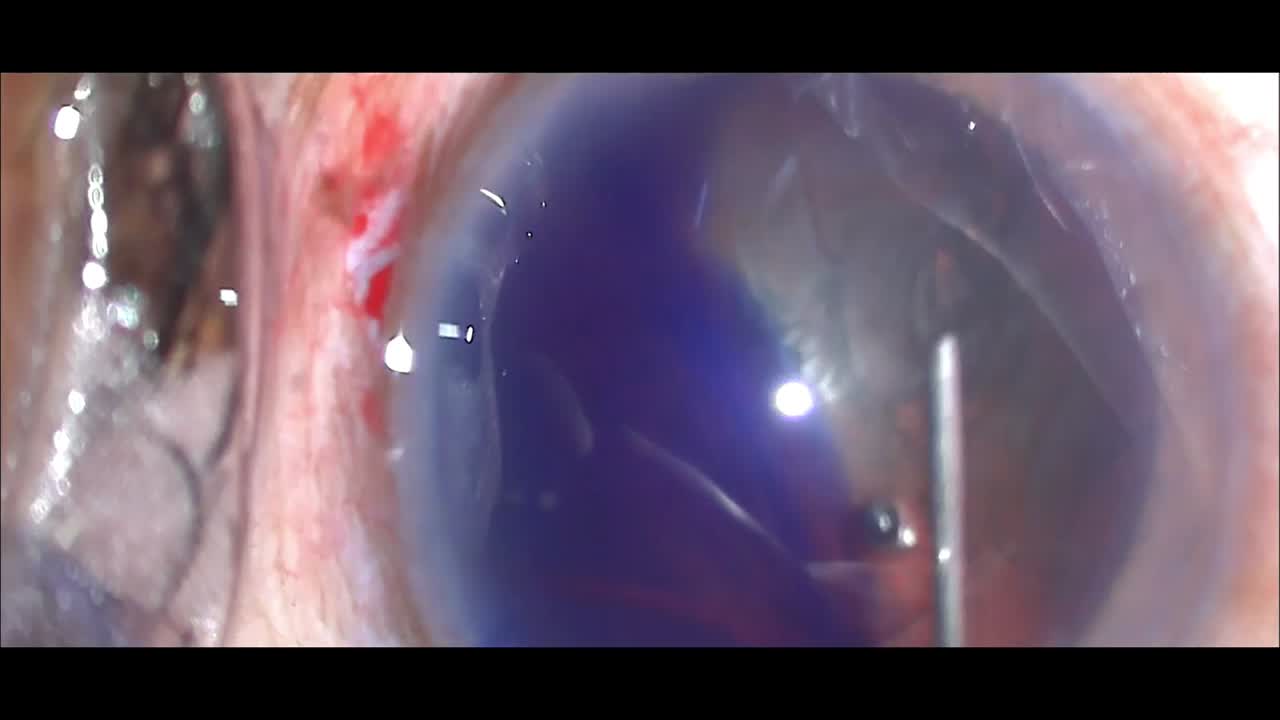 Blue Cornea