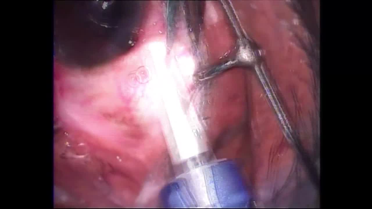 Injection Episiotomy