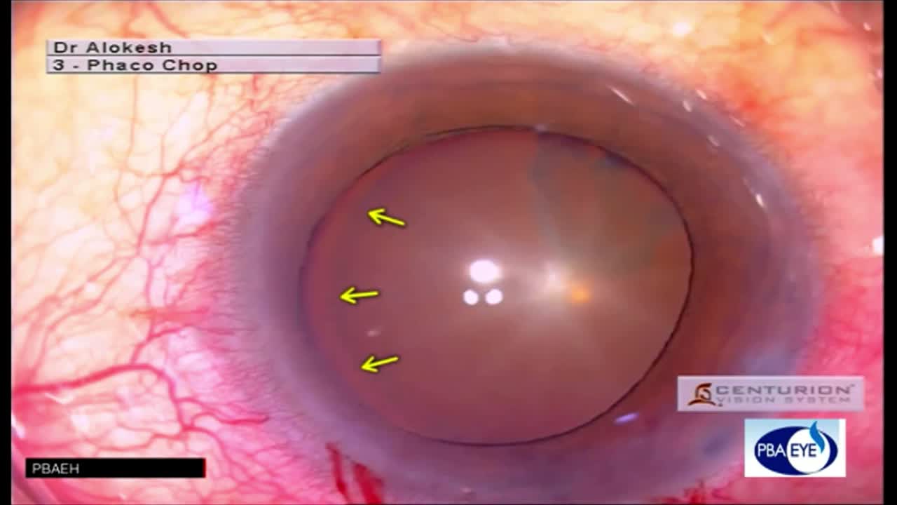 Anterior Capsule Tear – Did I Do That?