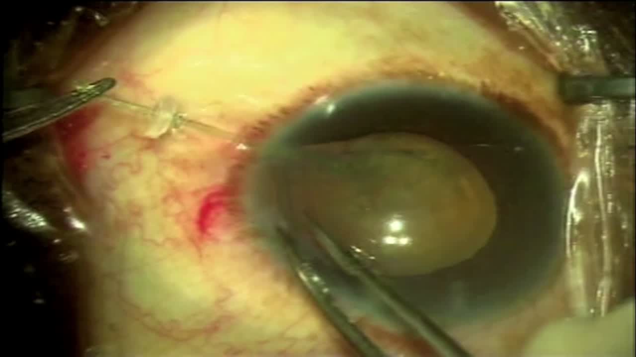 Coloboma with PC Tear Rescue