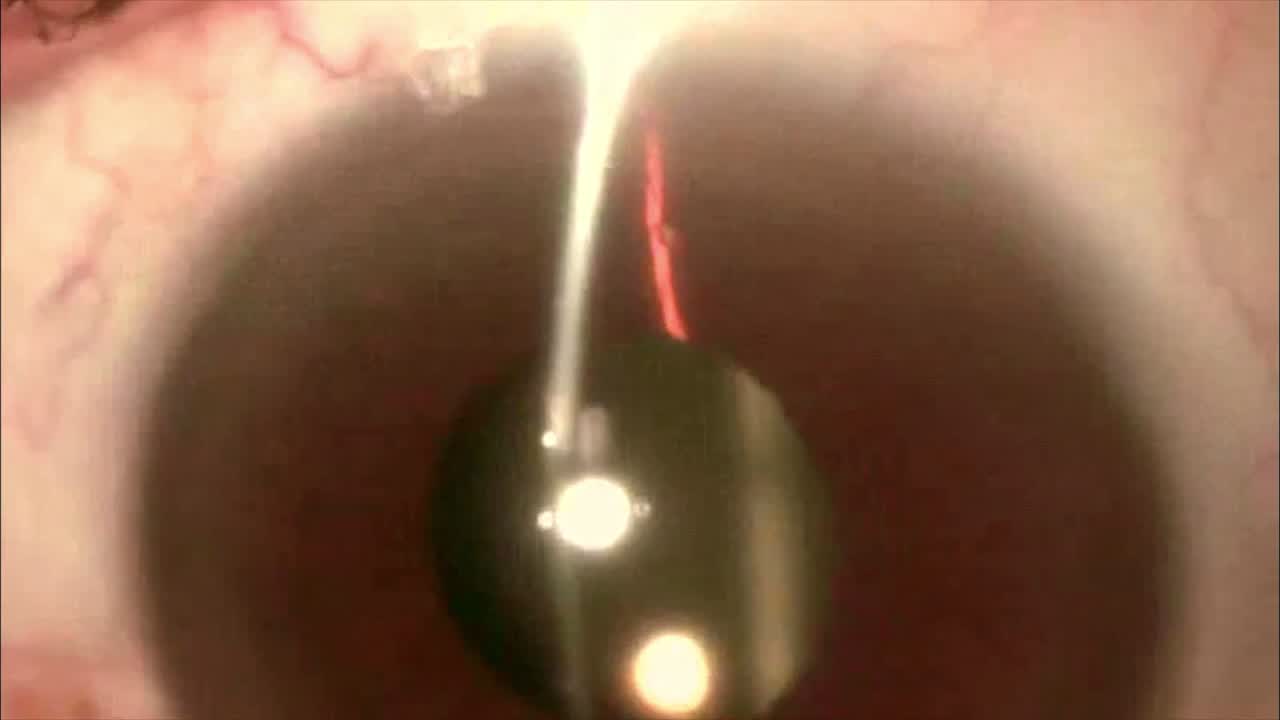 IOL? Capsule? Or In Between?