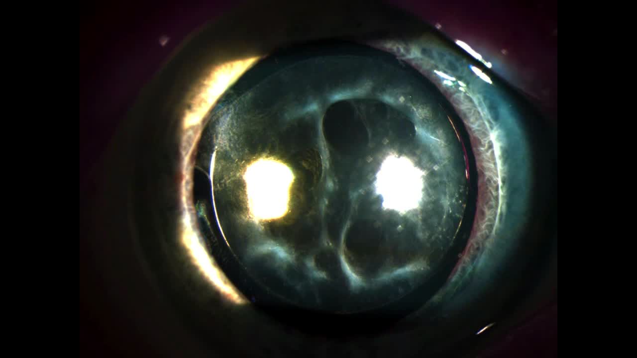 Opacified IOL or Capsular Membrane? 