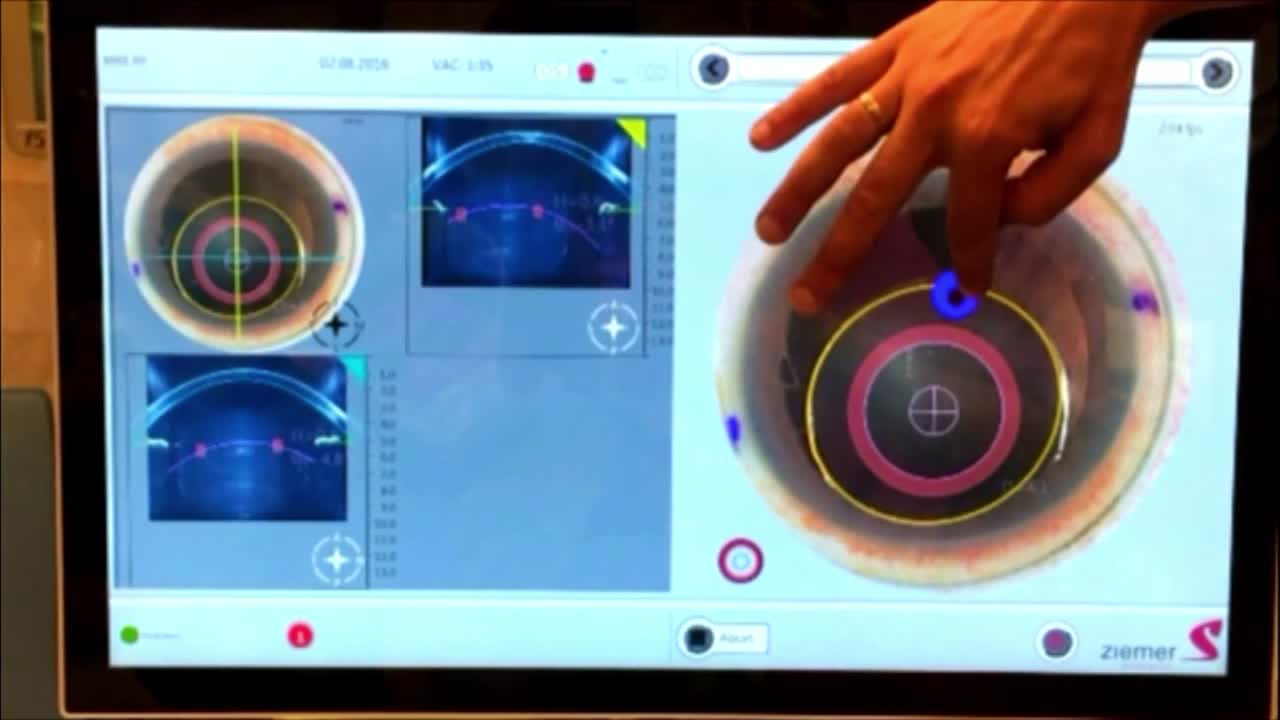 Capsular Contraction with Prolapsed Haptic