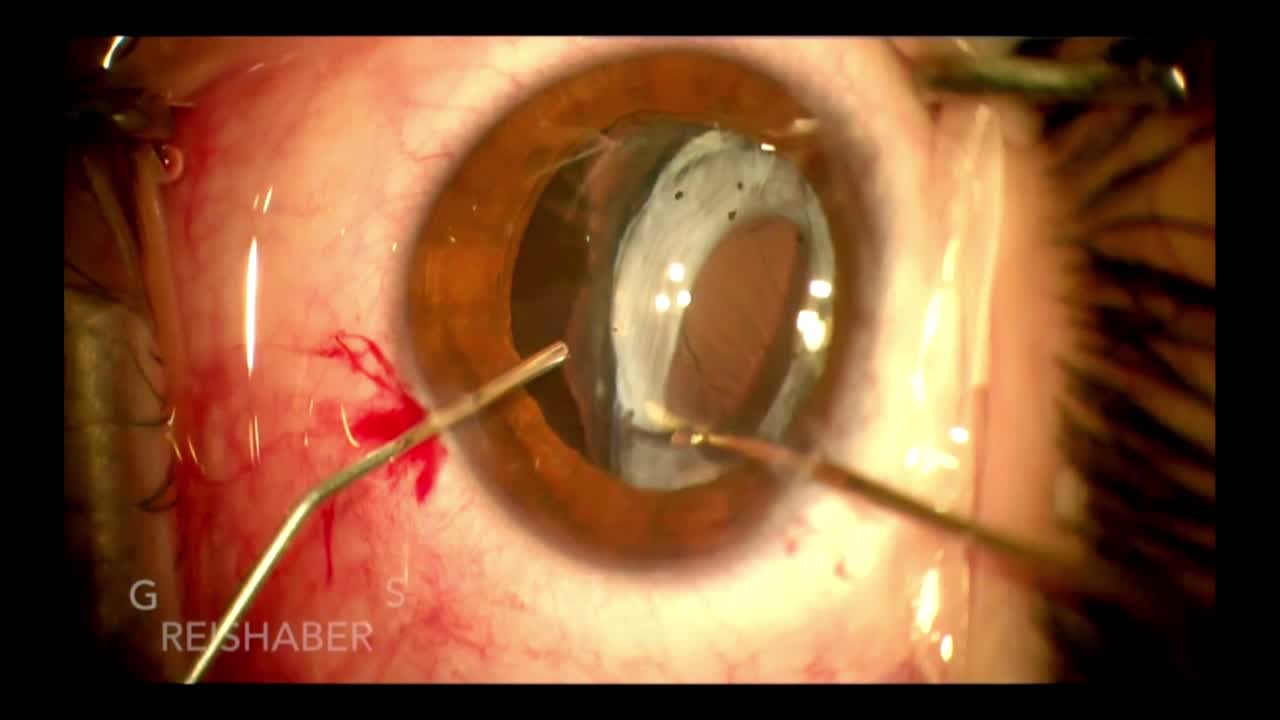 Capsular Fibrosis to Recenter Bag