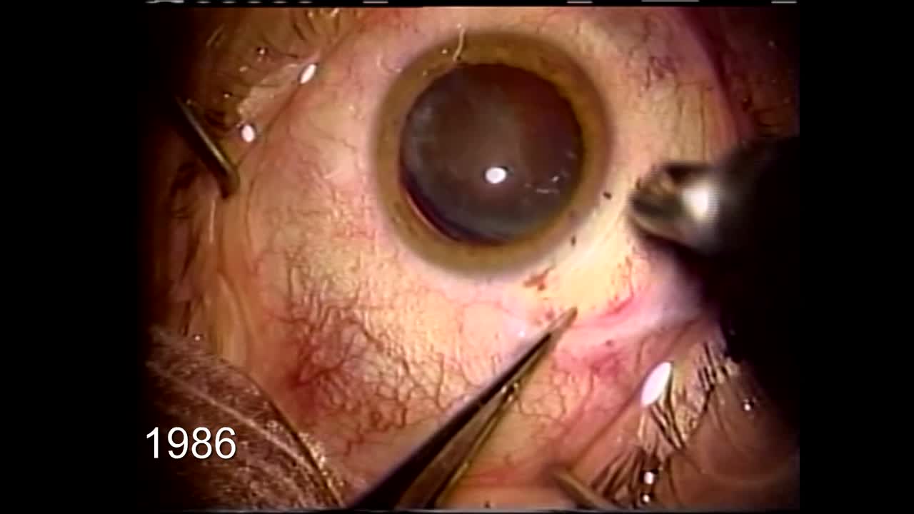 Emulsifying the Loose Lens: 1986