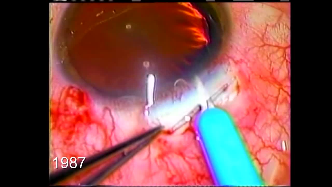 Suture Stabilization of the IOL: 1987