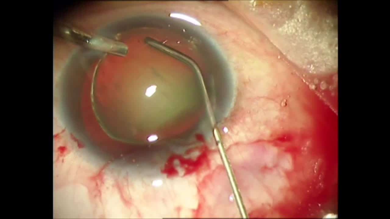 The Capsular Anchor
