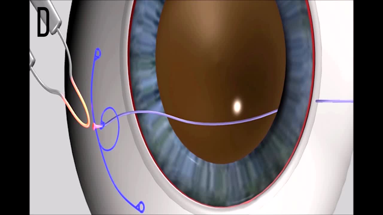 Double-Flanged Technique