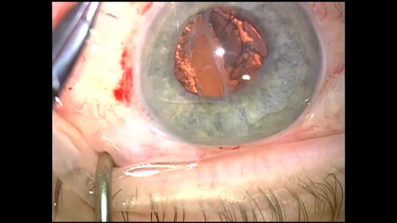 Subluxed IOL/Capsular Bag