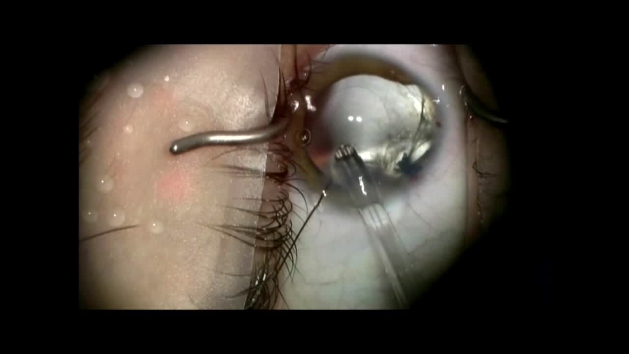 Suture Guidance