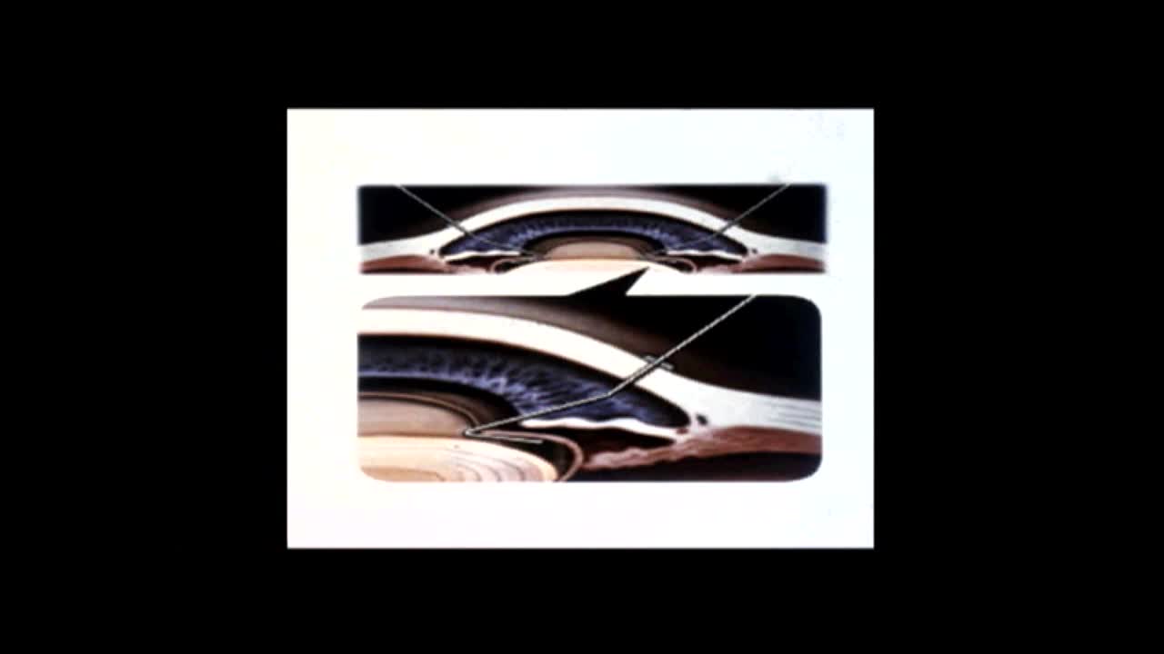 Capsule Retractors