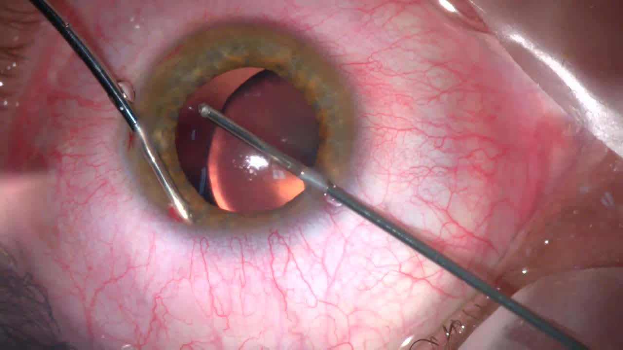 Permanent Retractors