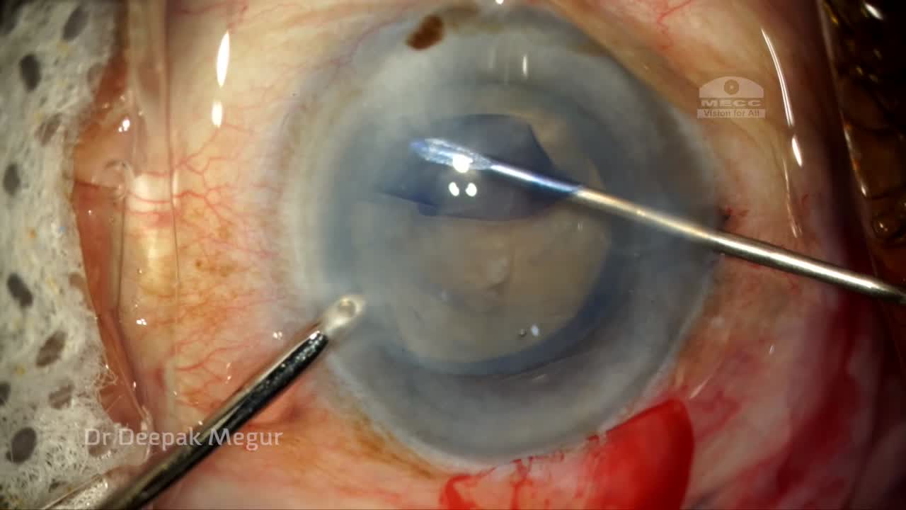 Descemet's Membrane Detachment