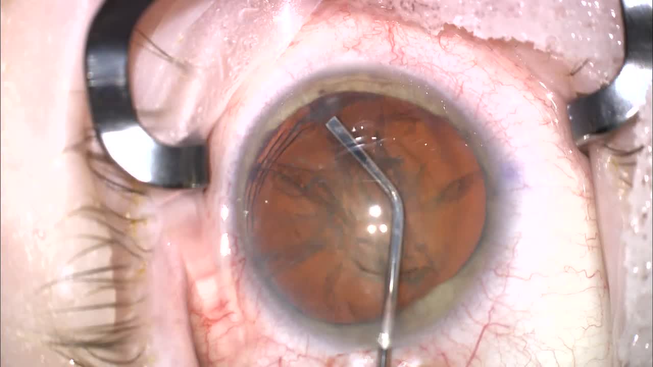 Management of Positive Pressure