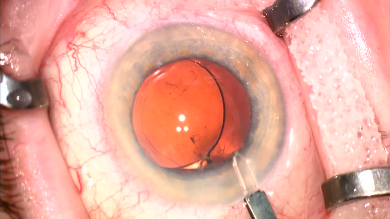Complicated IOL Insertions
