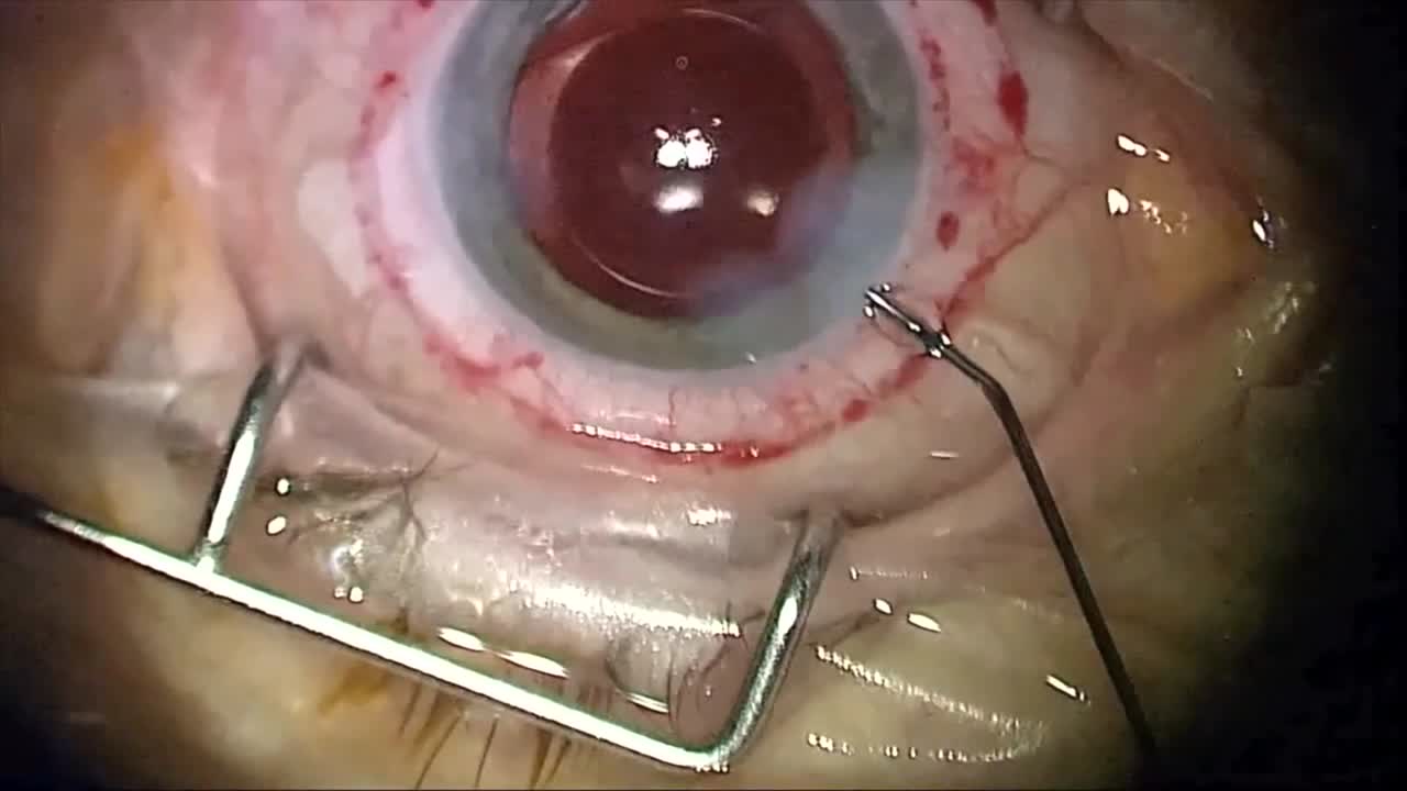 Leaky Incision: Sealant; Leaky Incision: Blood Aid