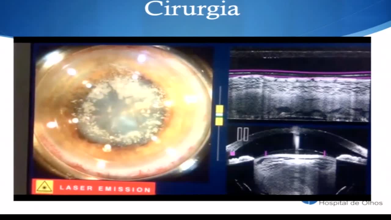 FLACS: Intumescent Cataract