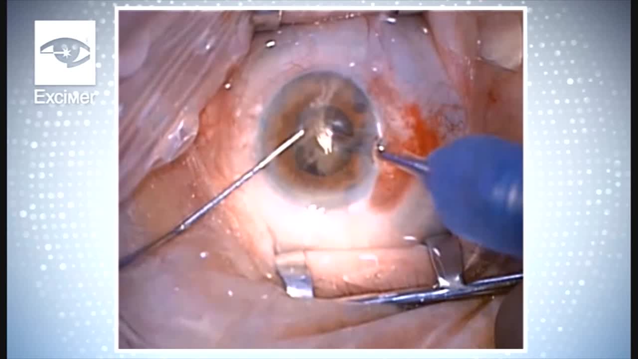 Scleral Rupture